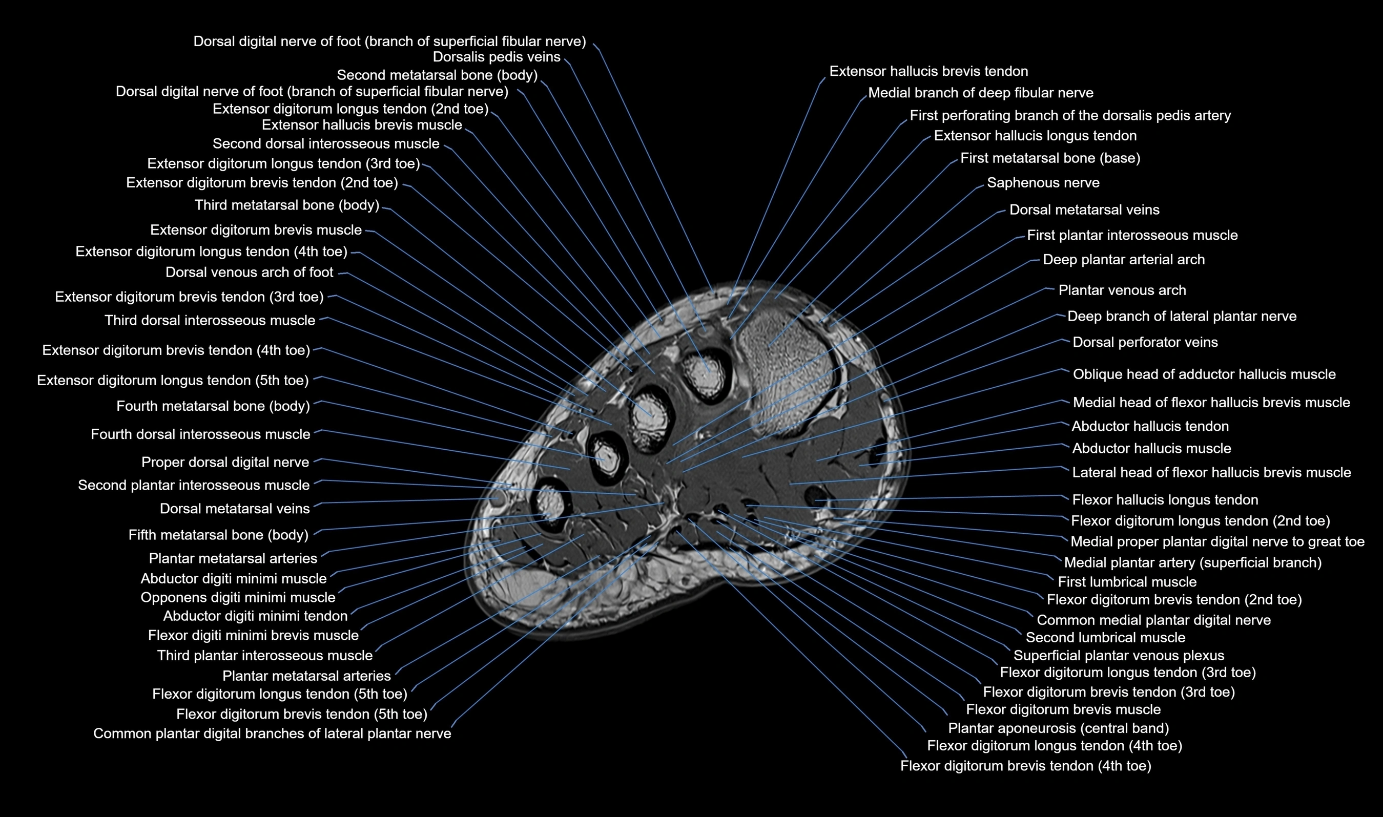 MRI mid foot axial cross sectional anatomy 3T  radiology  image-img-00001-00008.webp